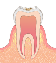 C1（エナメル質の虫歯）
