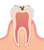 C2（象牙質の虫歯）