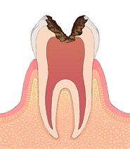 C3（神経に達した虫歯）