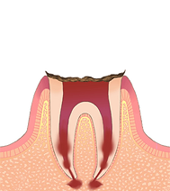 C4（歯根に達した虫歯）