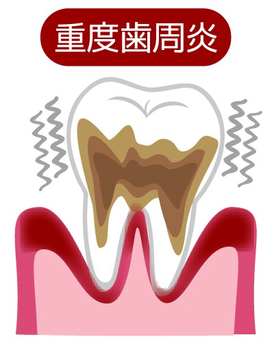 重度歯周病（歯周炎）